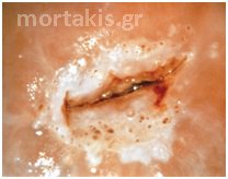HPV - HSIL