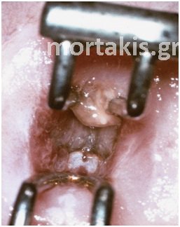Atypical Transformation Zone – 4. Colposcopic Findings of HSIL (CIN2, CIN3)