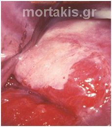 HSIL
