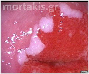 Atypical Transformation Zone – 3. Colposcopic Findings of LSIL (CIN1 and Condylomas)