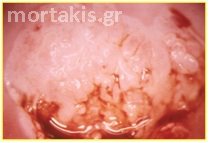 HPV - Ca