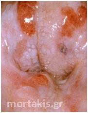 HPV - Ca