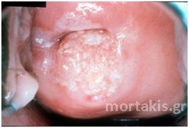 HPV - Ca