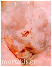 HPV - Ca