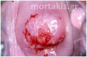 HPV - Ca