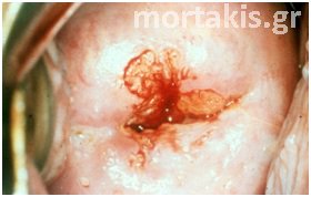 HPV - Ca
