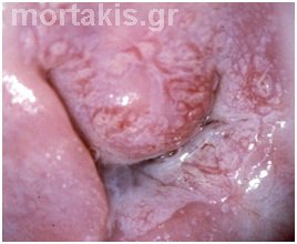 HPV - LSIL