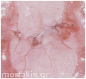 Atypical Transformation Zone – 5. Colposcopic Findings of Microinvasion & Invasion