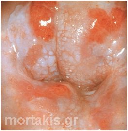HPV - HSIL