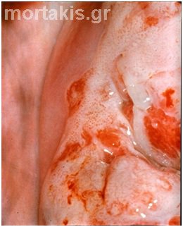 HPV - cancer