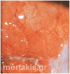 HPV - cancer
