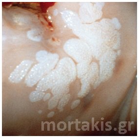 colposcopy