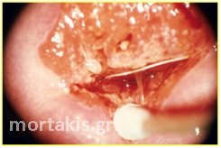 cervical cancer