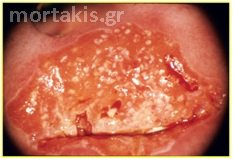 cervical cancer