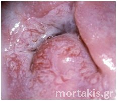 cervical cancer