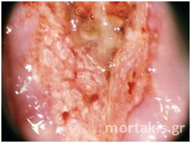 cervical cancer