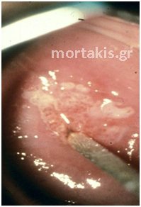 cervical cancer