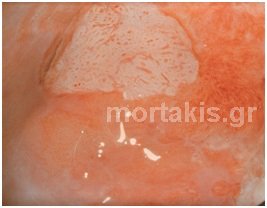 HPV