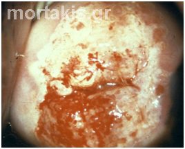 HPV - cancer