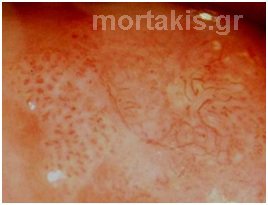 HPV