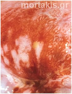 HPV - HSIL