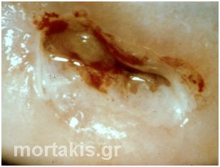 HPV - HSIL