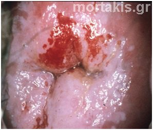 HPV - HSIL