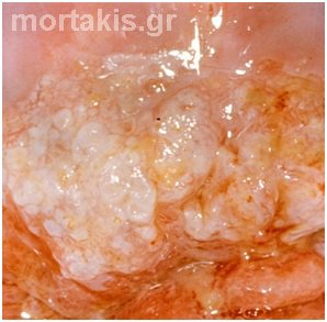 HPV - cervix
