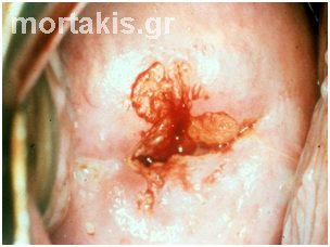 HPV - cervix