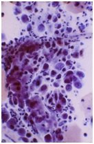 cervical cancer