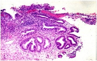 cervical cancer