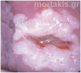 Atypical Transformation Zone – 6. Colposcopic Grading of Preinvasive Lesions
