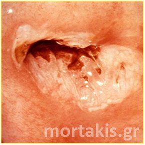 HPV - HSIL