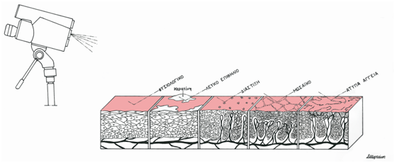 colposcopy