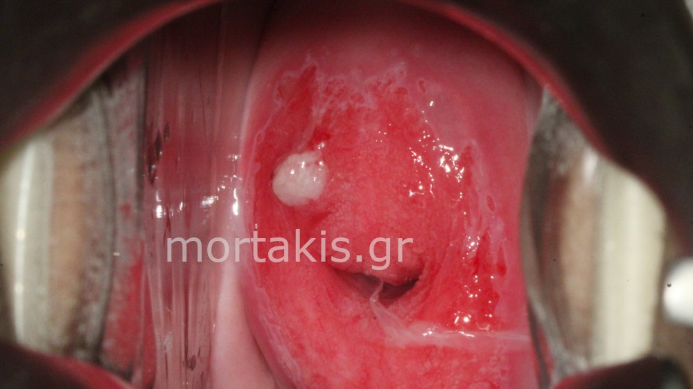 ADENOCARCINOMA IN SITU - Αδενοκαρκίνωμα