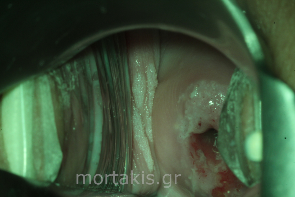 ADENOCARCINOMA IN SITU - Αδενοκαρκίνωμα