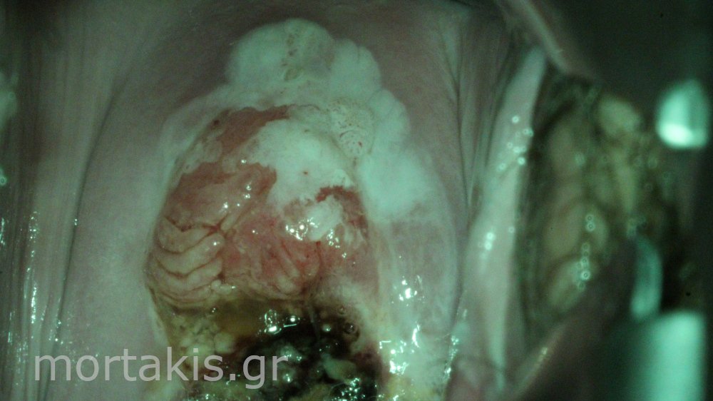CERVICAL CANCER - Καρκίνος τραχήλου μήτρας
