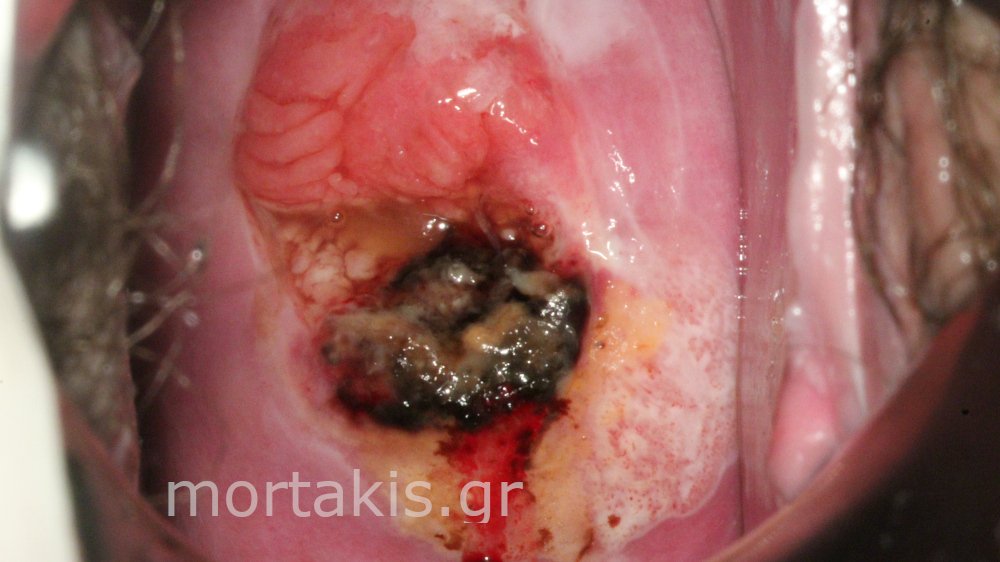 CERVICAL CANCER - Καρκίνος τραχήλου μήτρας