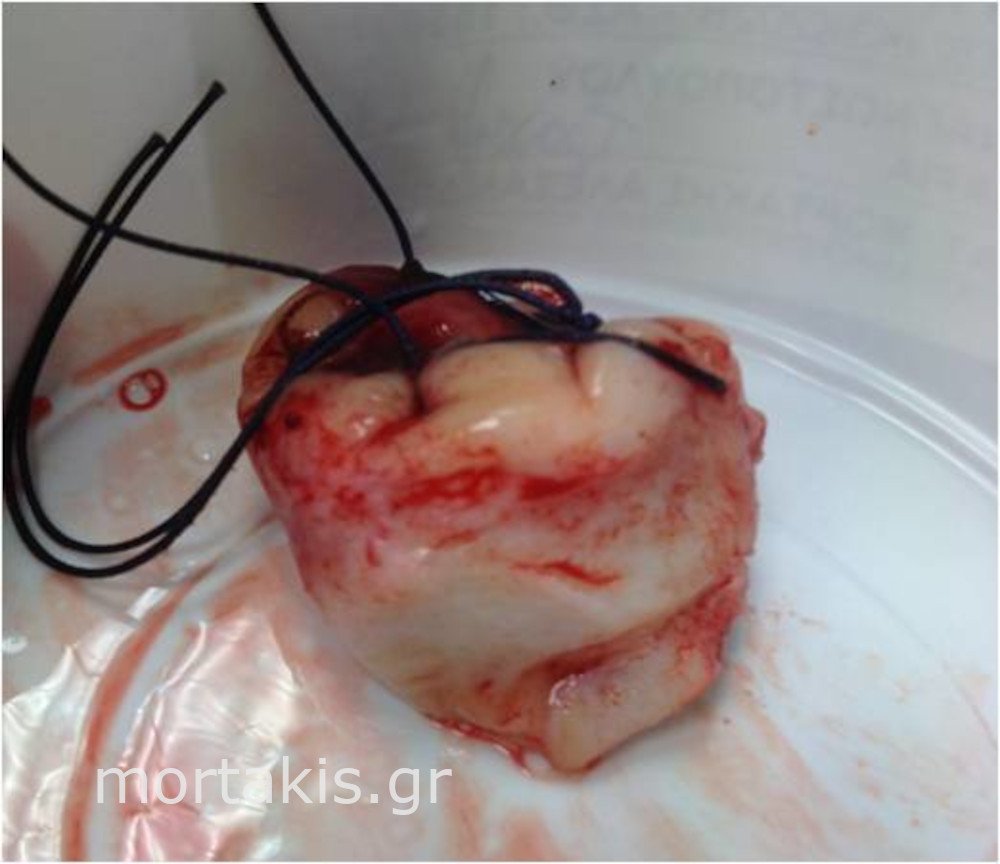 CERVICAL CONISATION - Κωνοειδής εκτομή