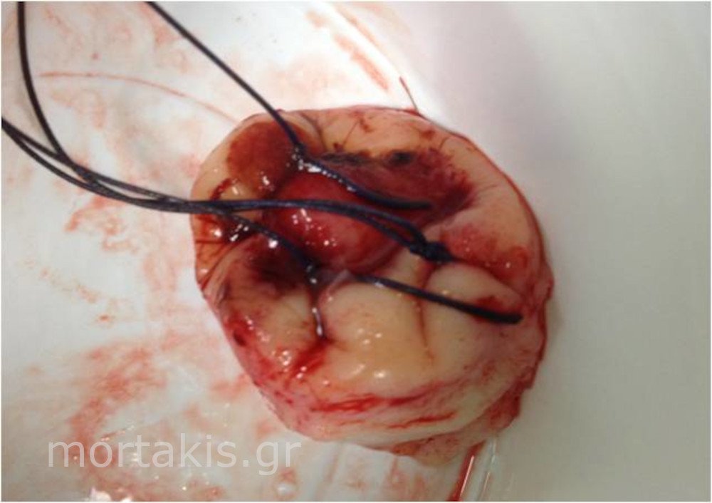 CERVICAL CONISATION - Κωνοειδής εκτομή