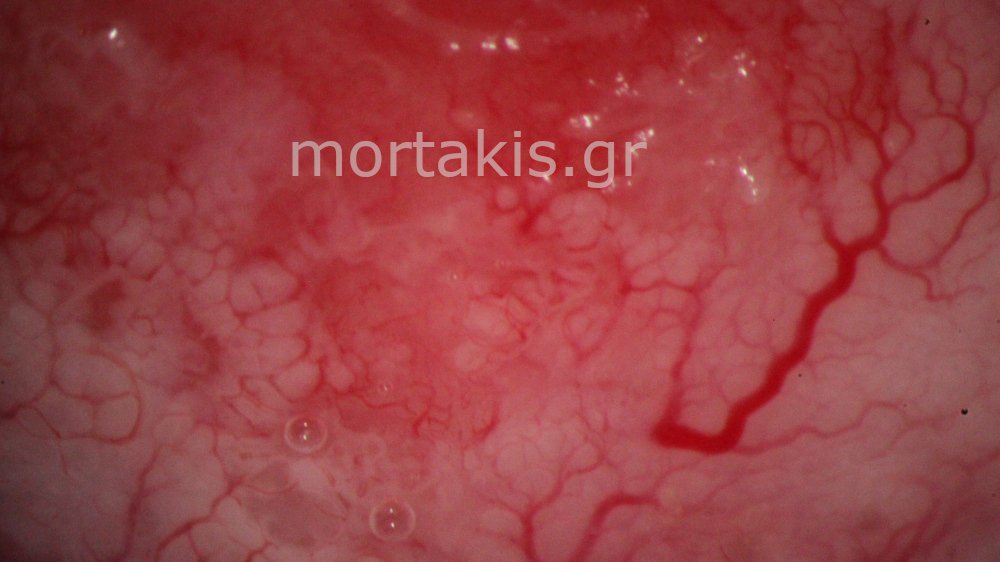 CERVICAL VESSELS - Αγγεία Τραχήλου Μήτρας