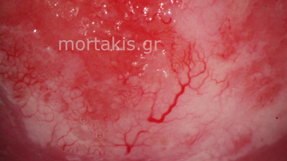 CERVICAL VESSELS - Αγγεία Τραχήλου Μήτρας