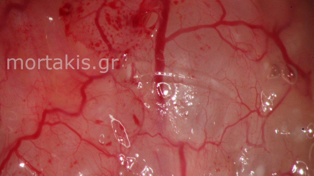 CERVICAL VESSELS - Αγγεία Τραχήλου Μήτρας