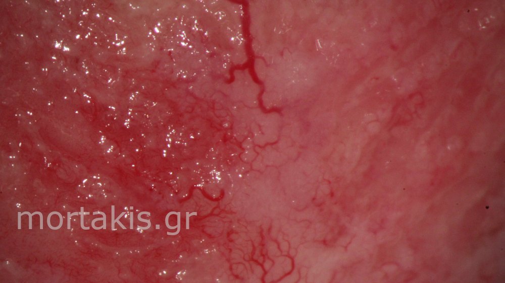 CERVICAL VESSELS - Αγγεία Τραχήλου Μήτρας