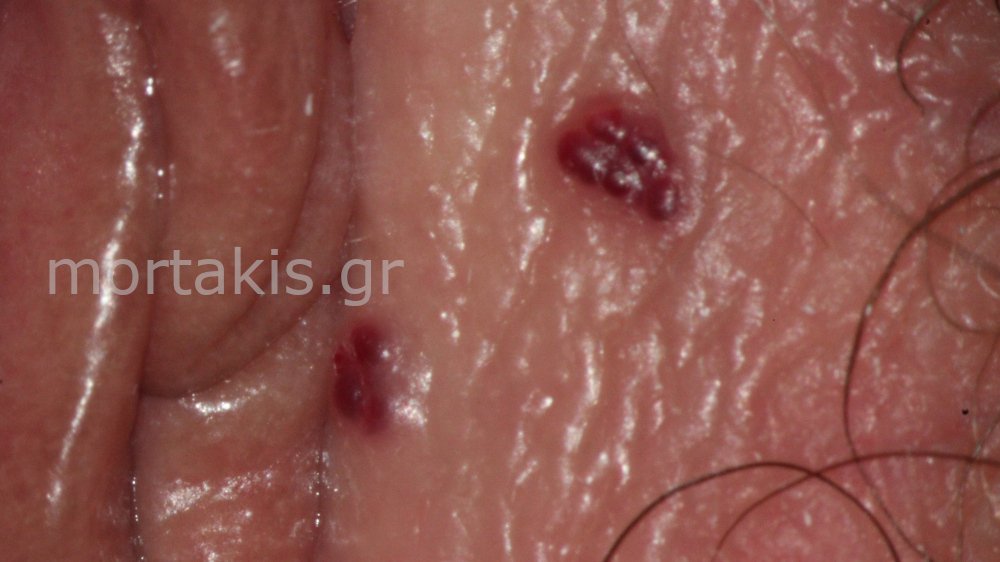 CHERRY ANGIOMAS OF THE VULVA - Αγγειοκερατώματα