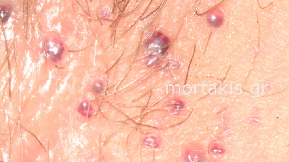 CHERRY ANGIOMAS OF THE VULVA - Αγγειοκερατώματα