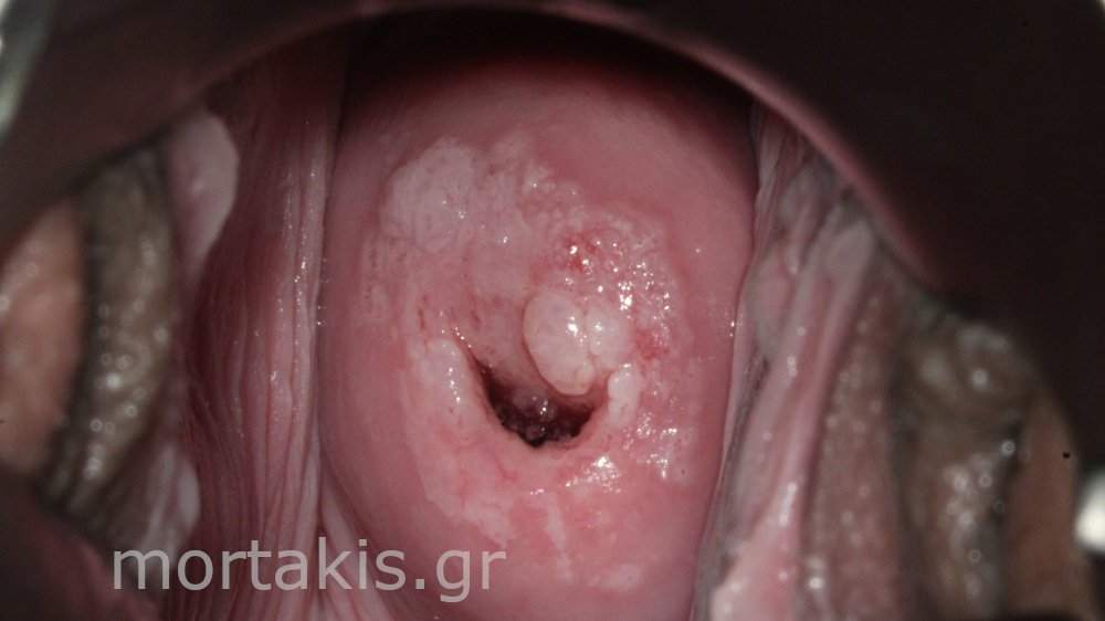 CIN1 AND CERVICAL WARTS - κονδυλώματα τραχήλου