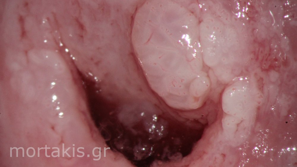 CIN1 AND CERVICAL WARTS - κονδυλώματα τραχήλου