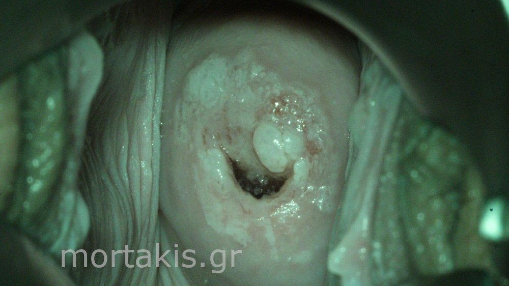 CIN1 AND CERVICAL WARTS - κονδυλώματα τραχήλου
