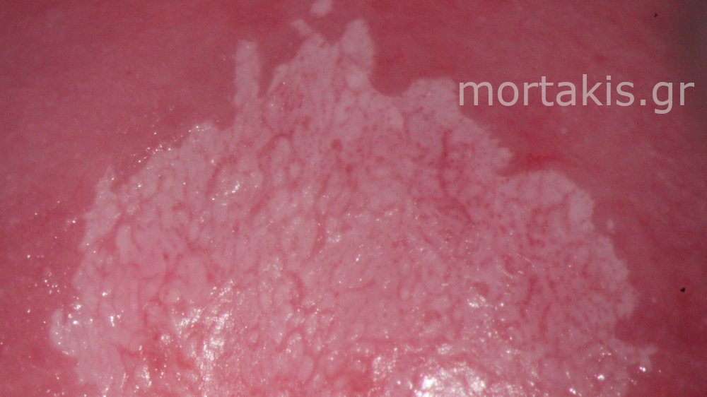 CIN1 LSIL CERVIX - Χαμηλού βαθμού αλλοίωσεις τραχήλου μήτρας